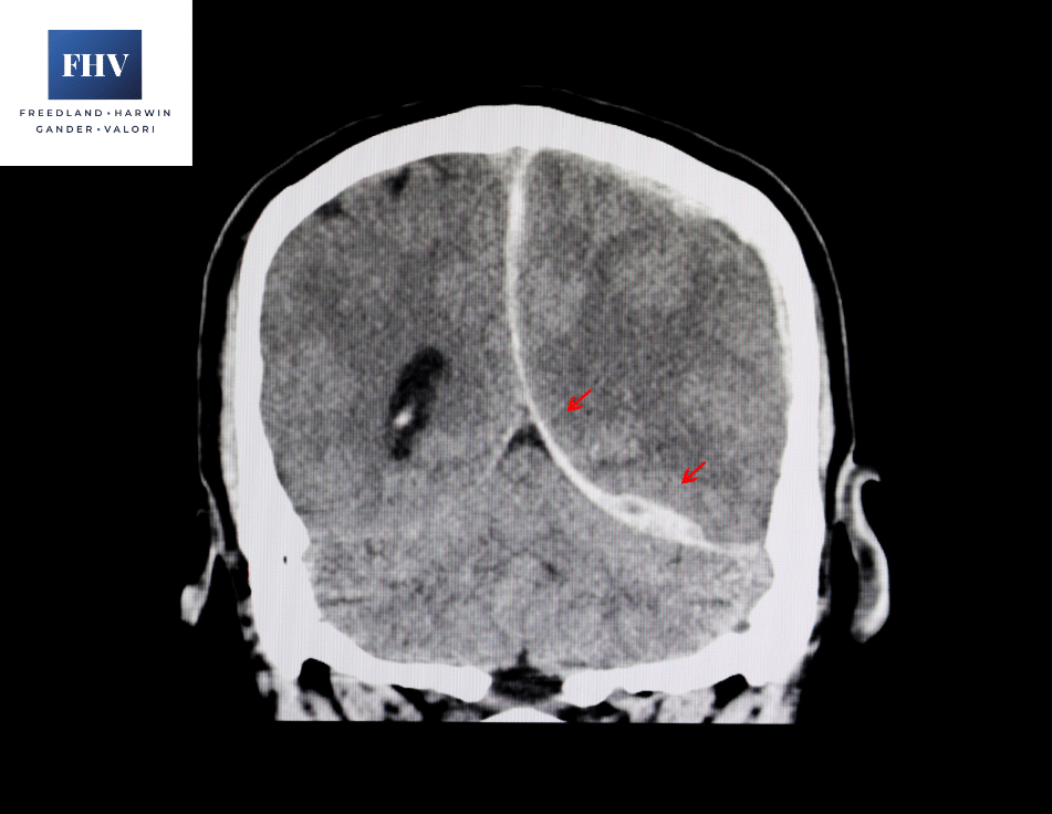 Image shows CT scan of a brain of a patient with interhemispheric hemorrhage from traumatic brain injury (TBI).